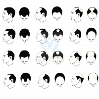 【U乐国际U乐基因检测】过早<font color='red'>脱发</font>、掉发太多怎么办？你的方法可能是错的！